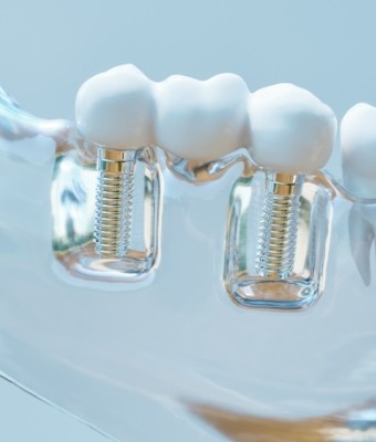 Model of dental bridge supported by two dental implants in Claremore
