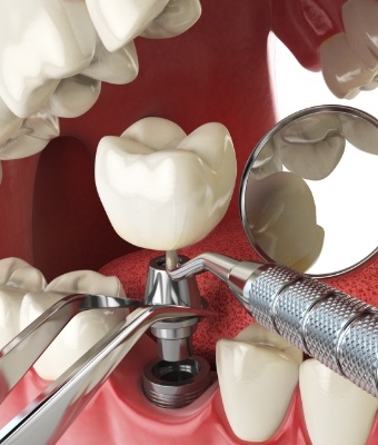 Animated dental implant being placed in the mouth