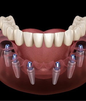 Six animated dental implants with a full implant denture