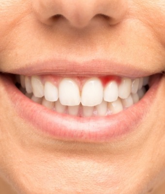Close up of smile with red spot on gums