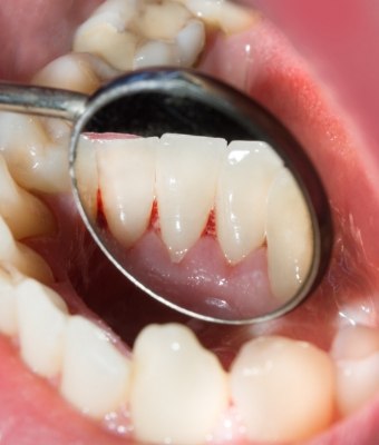 Close up of dental mirror in mouth with some red spots on gums