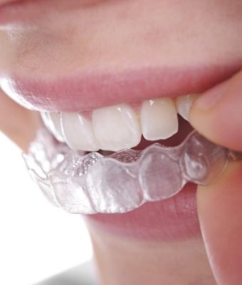 Close up of person placing a clear aligner over their teeth