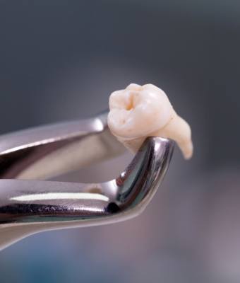 Tooth held in dental forceps after tooth extractions in Claremore